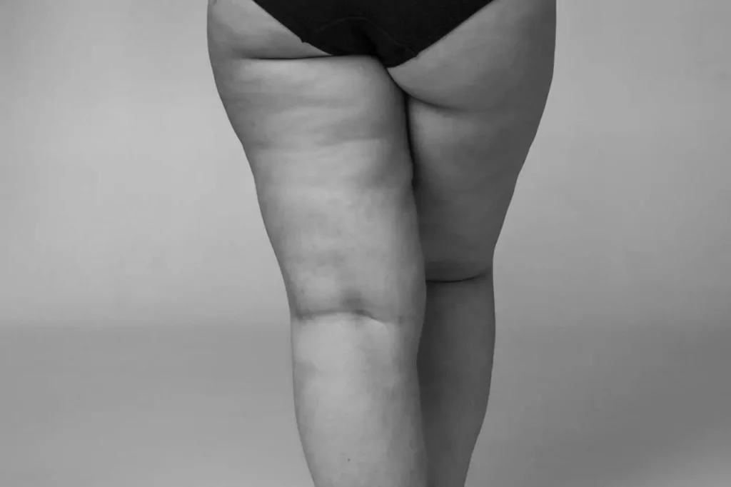 Jaki zabieg na cellulit? Sprawdź, co naprawdę działa